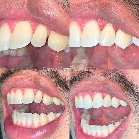 Cosmetic Dentistry Before/After – Williams & Patterson Family Dentistry