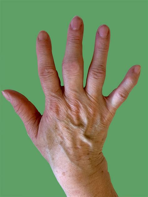 Osteoarthritis in the Hand – Aberdeen Virtual Hand Clinic