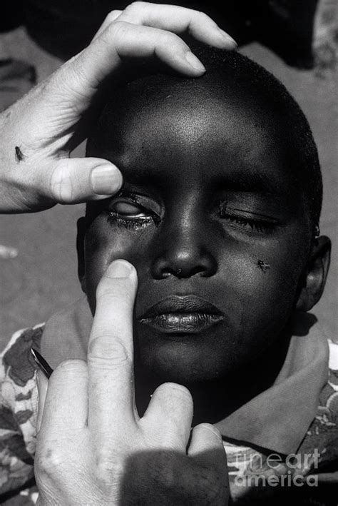 Trachoma Eye Infection Treatment Photograph by Jason Kelvin/science Photo Library - Pixels