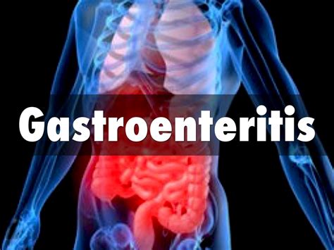 Gastroenteritis by Amy Ponder