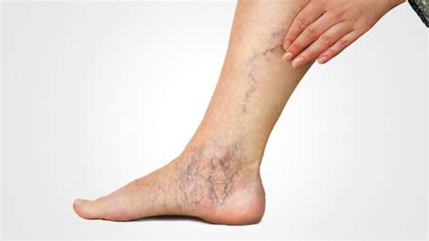 Varicose veins - main symptoms and treatments