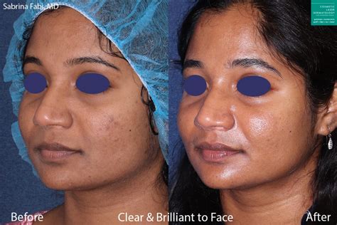 Clear + Brilliant Laser Resurfacing | San Diego, CA | CLDerm