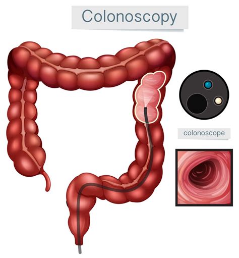 Diagram Of Colonoscopy