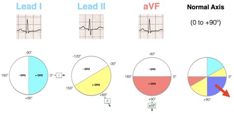 ECG Axis Interpretation • LITFL • ECG Library Basics