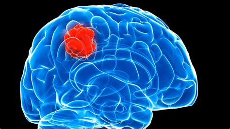 Glioma - Causes, Signs, Symptoms,Type, Diagnosis & Treatment