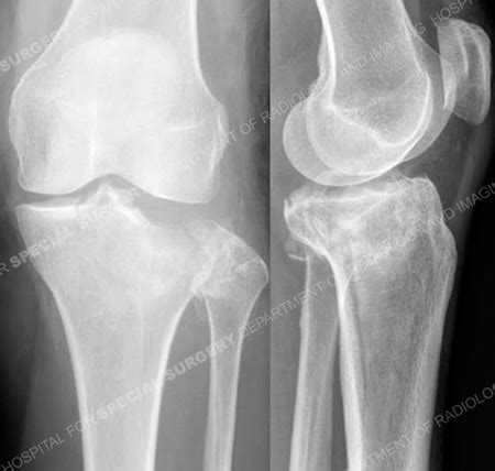 Knee Fractures - Orthopedic Trauma Service - HSS