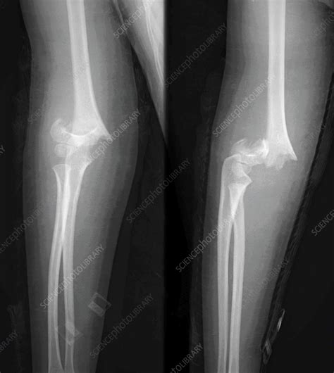 Supracondylar fracture, X-ray - Stock Image - F036/0251 - Science Photo ...