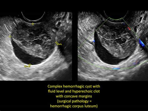 Hemorrhagic Cyst Ultrasound