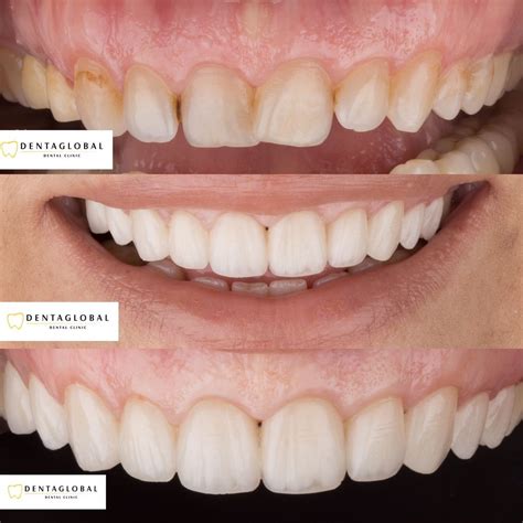 Before-After Pictures | DENTAGLOBAL. Dental Implants, Cosmetic Dentistry, Teeth Whitening ...