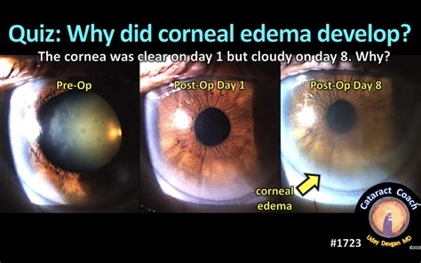 1723 quiz corneal edema – Cataract Coach™