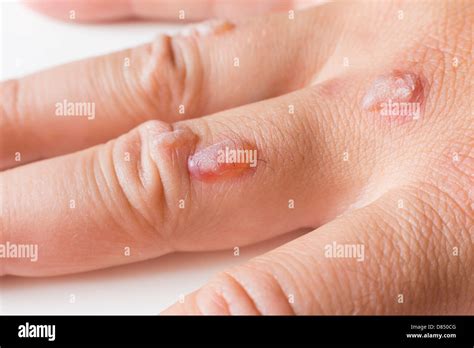 Man's hand covered with blisters caused by cryosurgery - wart removal procedure using liquid ...