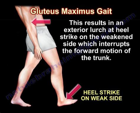 gluteus maximus gait I lurching gait - PHYSIO STUDY