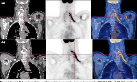 Figure 1 from Brachial Plexus Metastasis Masquerading as Radiation ...