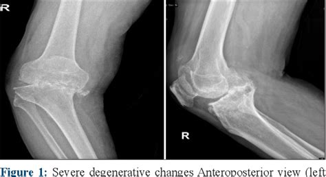 Figure 1 from Total synovectomy and total knee arthroplasty in old patient with pigmented ...