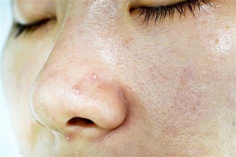 Whiteheads on Nose: Causes, and How to Get Rid of Them ASAP