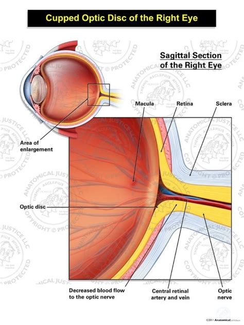 Normal Right Optic Disc