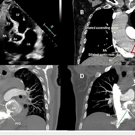 TTE and contrast-enhanced chest CTA with pulmonary embolism protocol.... | Download Scientific ...