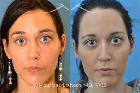 NYC Wide Bridge Nose Correction Surgery | New York Nasal Bridge Rhinoplasty