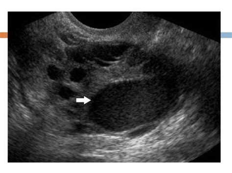 Endometriosis by Ultrasound