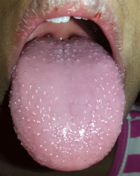 Strawberry Tongue | NEJM