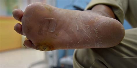 Learn about the Cause and Prevention of Diabetic Foot Ulcers | WCEI