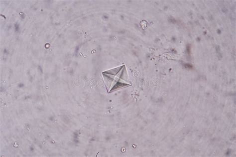 Calcium Oxalate Crystals In Synovial Fluid