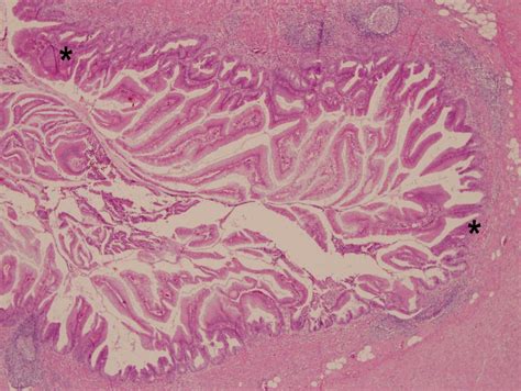 Perforated acute appendicitis resulting from appendiceal villous adenoma presenting with small ...