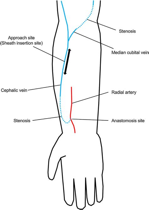 Arm Fistula Anatomy at Antonia Randall blog