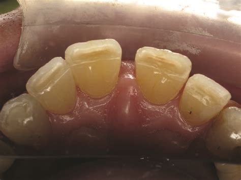 Show Your Work: Treating Incisal Edge Wear by Dr. Marvin Fier - Dentaltown