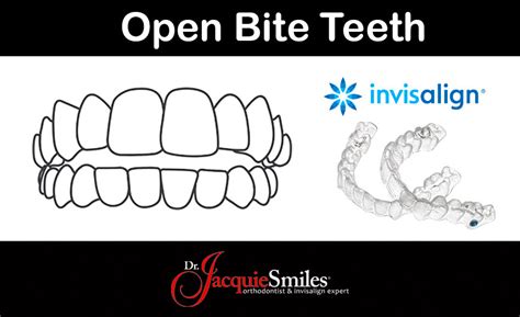 Invisalign Treatment for an Open Bite in Monroe, NYDr. Jacquie Monroe Ortho