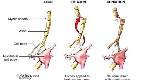 Diffuse axonal injury - Injury Choices