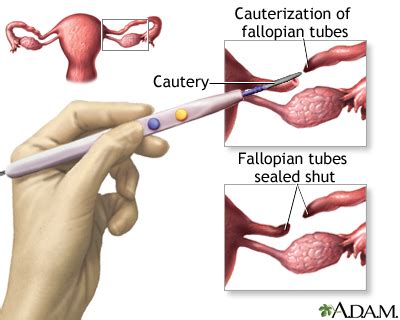 Tubal ligation | UF Health, University of Florida Health