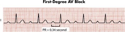 First degree atrioventricular block - ECG ~ Medicine Hack