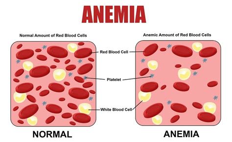 Negative Health Effects of Iron Deficiency & Associated Diseases ...