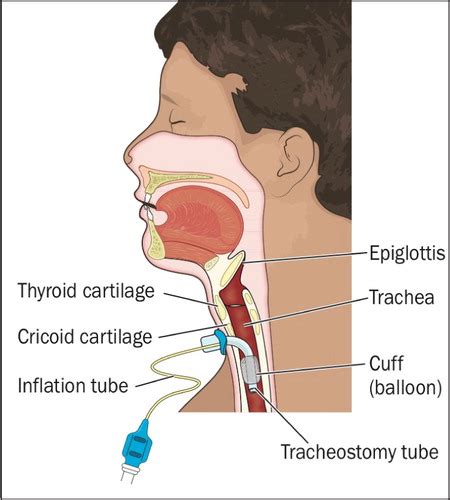 Tracheostomy Care