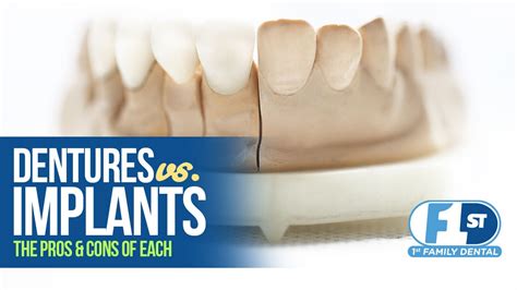 Dentures vs Implants: Pros and Cons - 1st Family Dental Blog