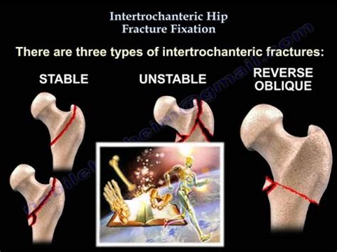 😊 Complete comminuted intertrochanteric fracture of the right hip. Chapter 6 Case Study on Bone ...