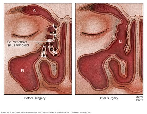 Nasal polyps Disease Reference Guide - Drugs.com