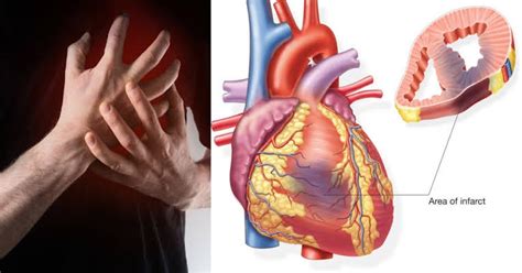 Serum Enzymes and Cardiac Markers - Nurses note help