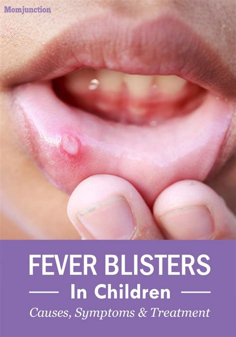 Cold Sores (Fever Blisters) In Kids: Causes And Treatment