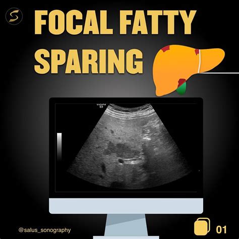 📝FOCAL FATTY SPARING IN A DIFFUSELY... - Salus sonography