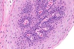 Squamous papilloma of the esophagus - Libre Pathology