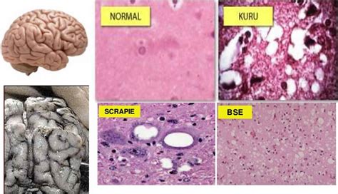 Mad Cow Disease In Humans Symptoms