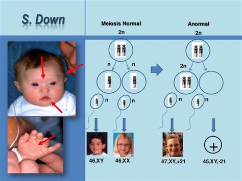 Sindrome down