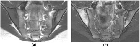 Sacroiliac Joint Erosion