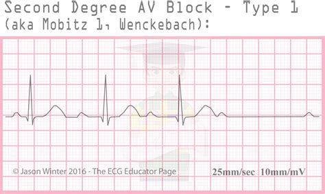 ECG Educator Blog : Heart Blocks