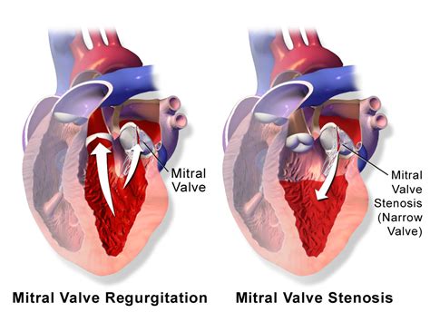 Rheumatic Heart Disease is the most common form of heart disease found ...