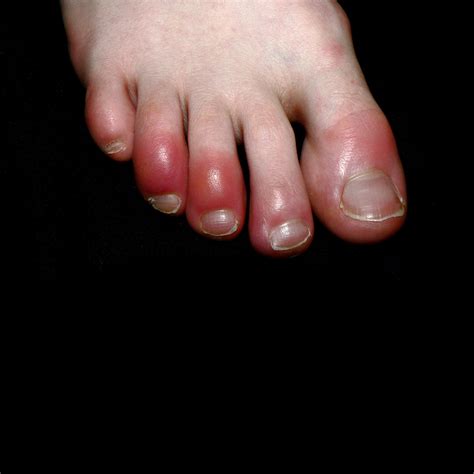 Covid Toe / Covid Toes Pernio Like Lesions Sciencedirect - kiraplasjtw28