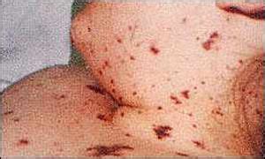 Sepsis Rash Images