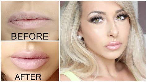 GETTING LIP INJECTIONS!! Juvederm (lip injections) before and after ...